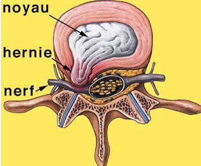 Osteokhondroz du service cervical du traitement de lexercice